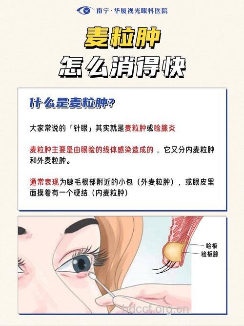 中医有哪些治疗麦粒肿方法