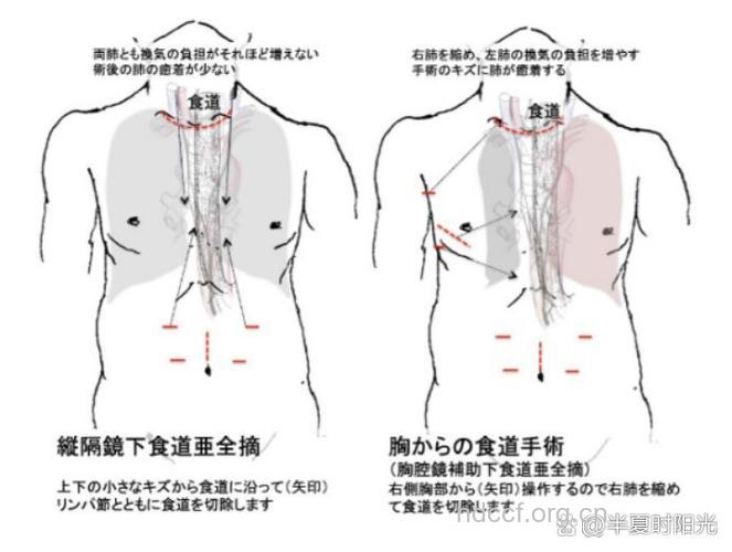 怎么手术辩证疗食道癌方法