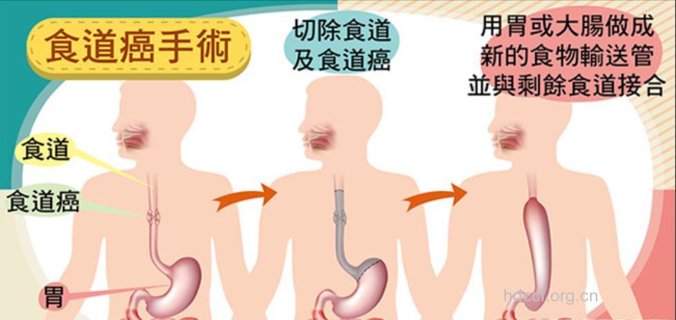 老人食道癌有哪些治疗方法