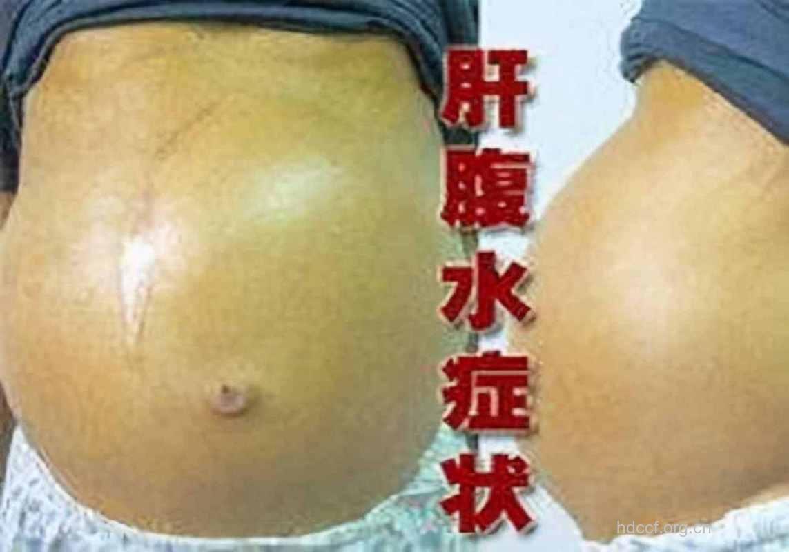 肝硬化晚期的症状有哪些