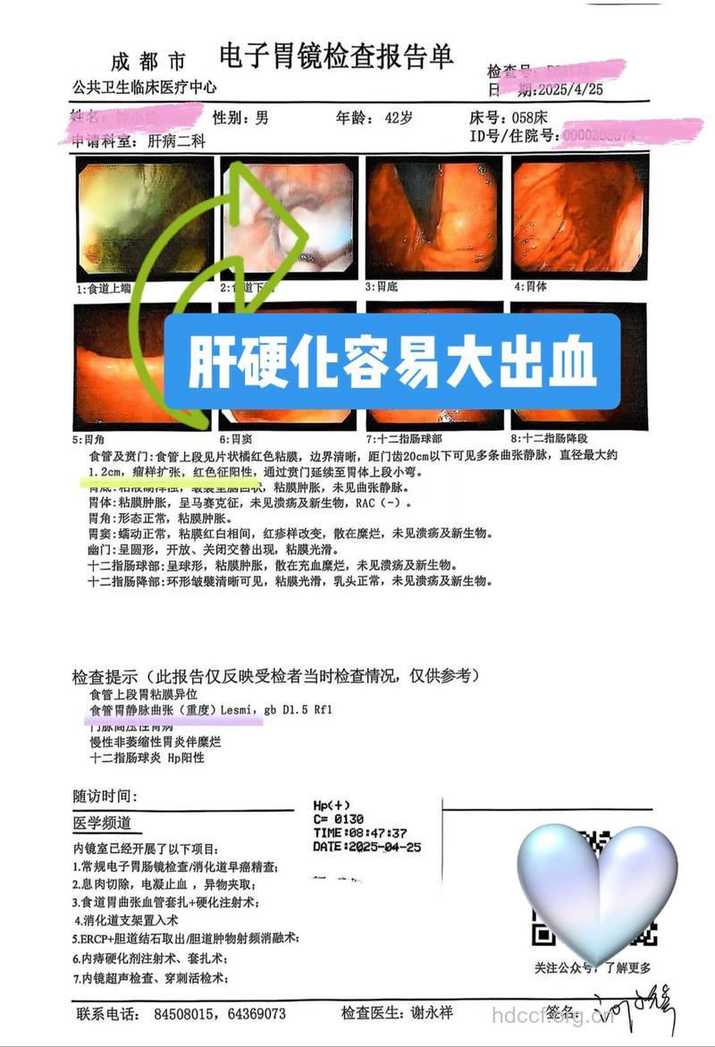 肝硬化并发消化道出血的治疗