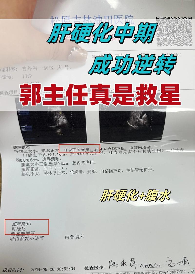 肝硬化腹水可以治好吗?