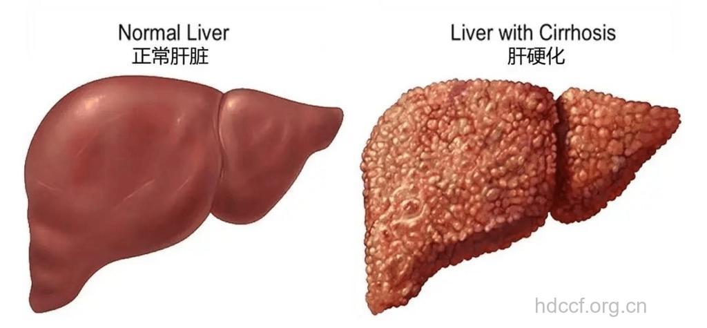 肝硬化为什么会引起内分泌失调