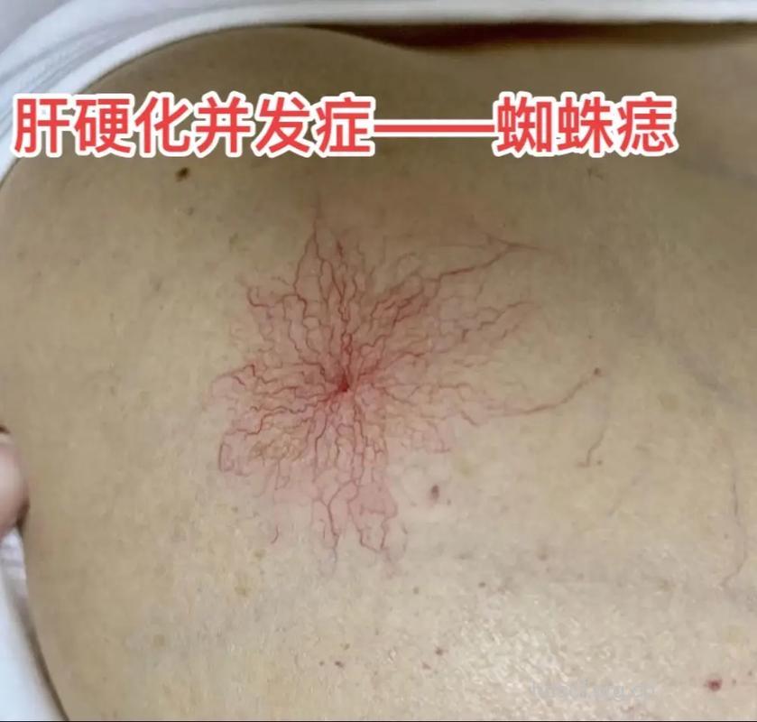 得了肝硬化为什么会出现蜘蛛痣