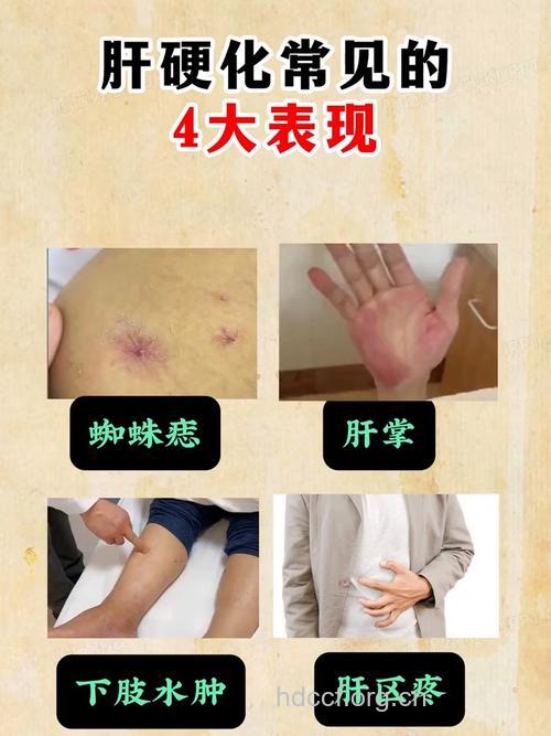 肝硬化有哪些症状