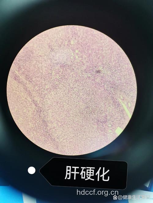 肝硬化治疗面面观