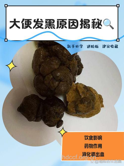 肝硬化为什么大便发黑