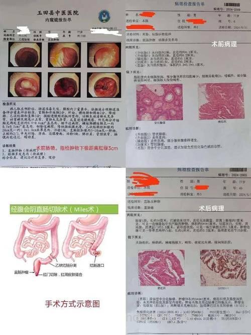 直肠癌的诊断检查手段