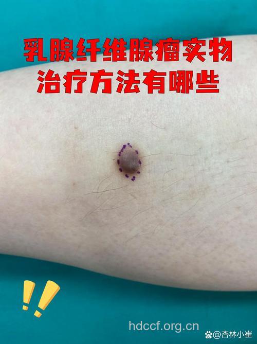 女性易患的良性肿瘤有哪些?