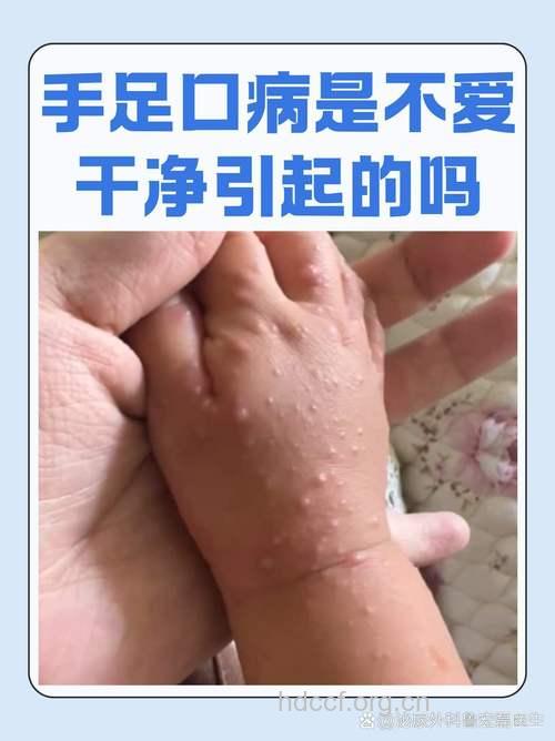 5-7月手足口病的高发期