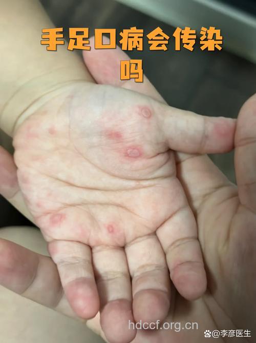 手足口病的感染人群