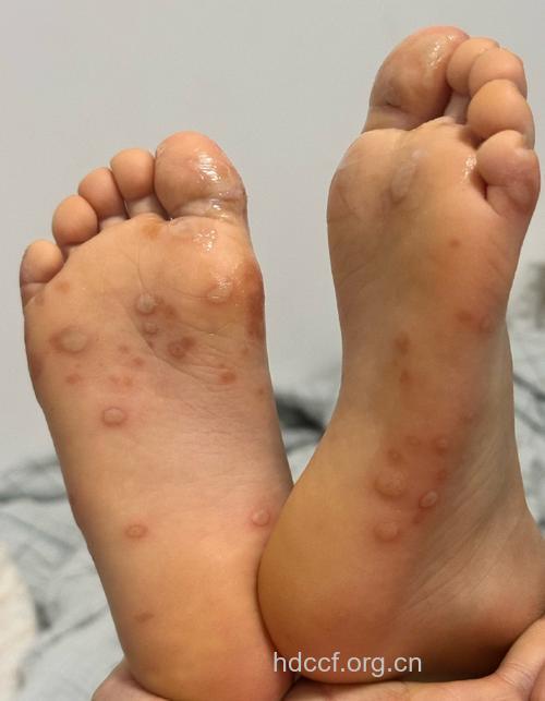 手足口病病发症状
