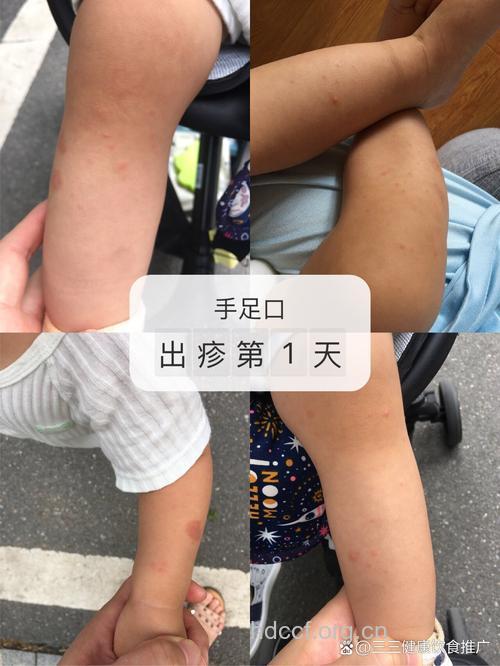 手足口病有哪些症状？