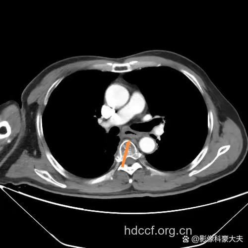 食道癌诊断新方-内镜超声扫描