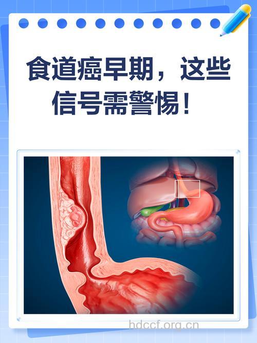 连续不断打嗝是食道癌警告信号