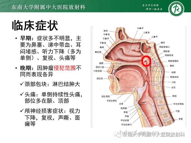 鼻咽癌常用的三点组织学类型