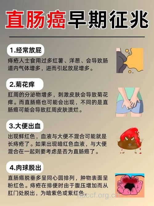 女性需警惕的三种大肠癌症状