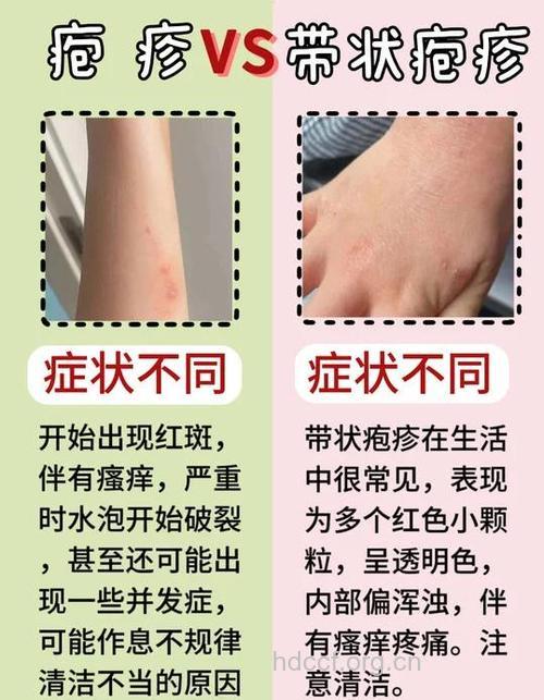初春应该小心哪些皮肤病