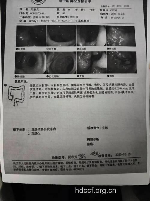疑似肠癌需要进行哪些诊断