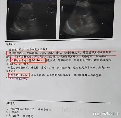 超声诊断酒精肝的价值