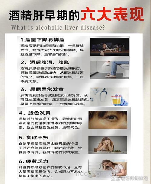 酒精肝早期有什么症状表现呢