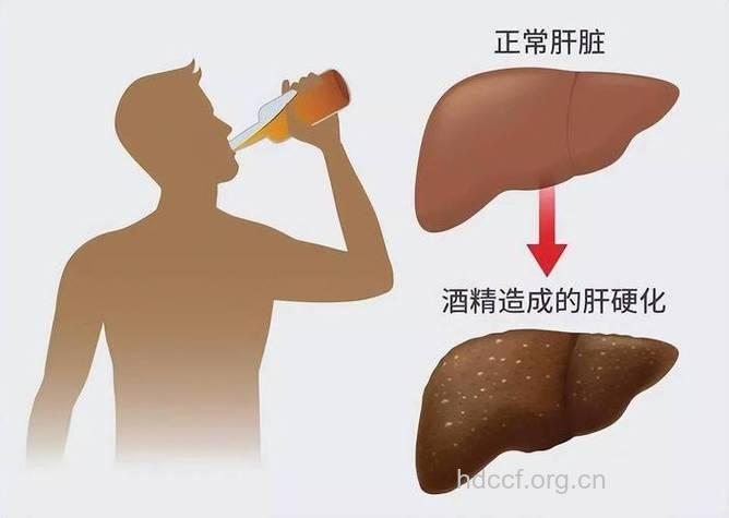 酒精肝患者年轻化