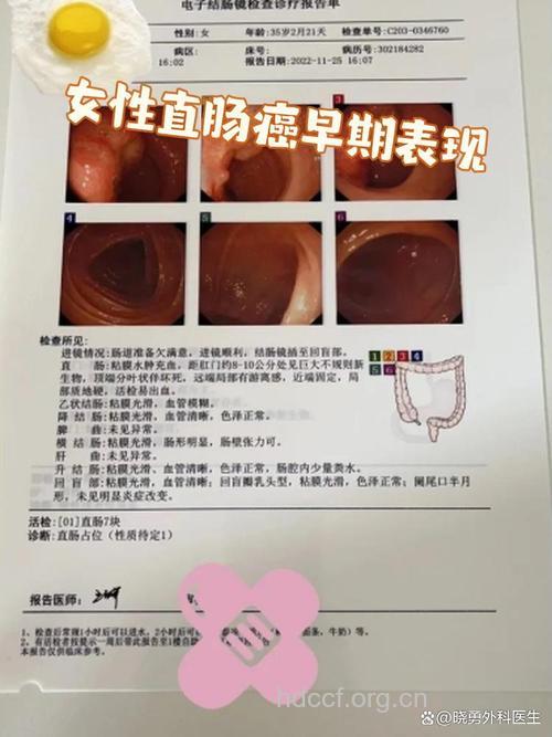 大肠癌早期有什么表现