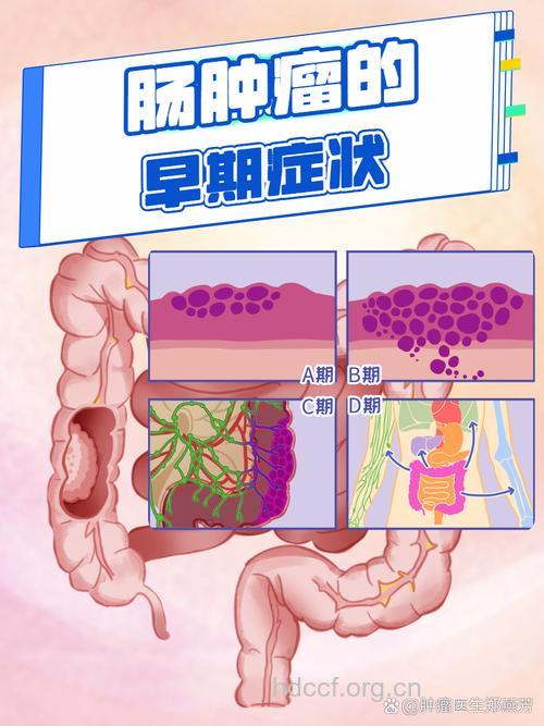 大肠肿瘤早期症状都有哪些