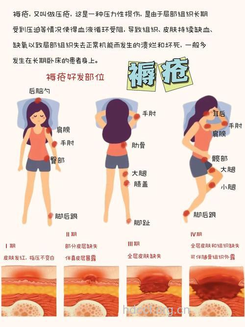 大肠癌患者褥疮的防治方法