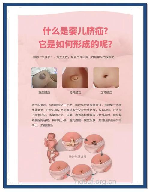 新生儿得了脐疝怎么办?
