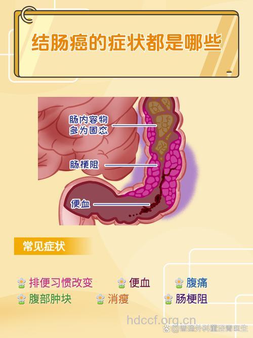 结肠癌有哪些典型症状