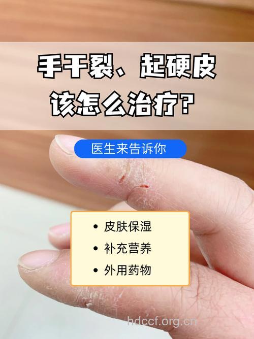 你知道怎么预防皮肤皲裂