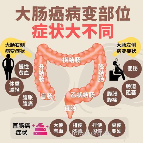 大肠肿瘤发病原因是什么呢