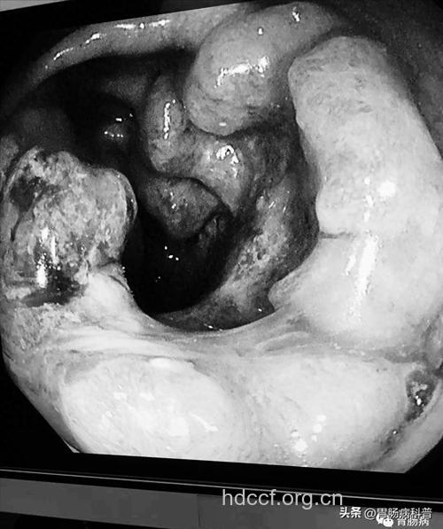 大肠癌的隐身衣