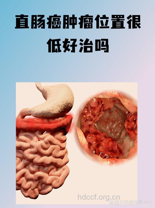 生物治疗大肠癌效果好吗