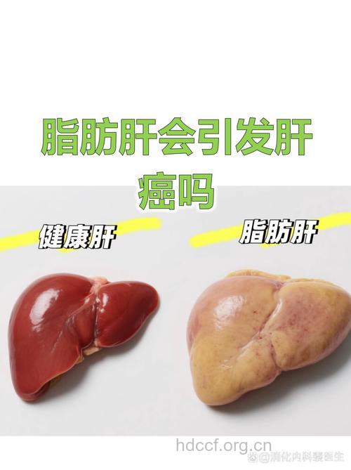 这种脂肪肝会变成肝癌 大肚男人要小心