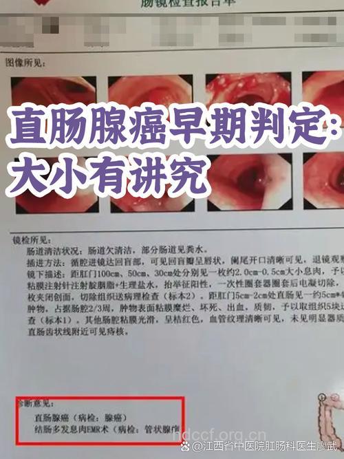 早期大肠癌症状是什么