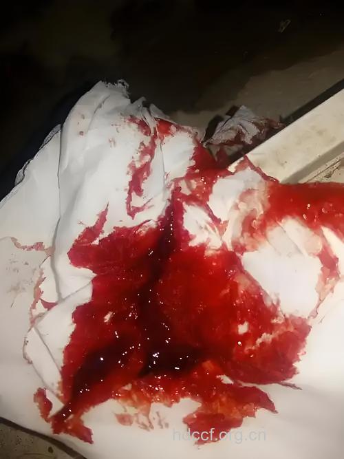 大肠癌会出现大便带血吗