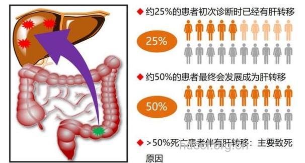 怎么预防大肠癌肝转移方法