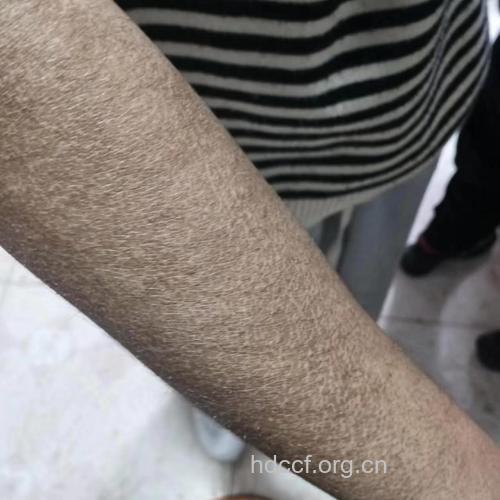 带您认识什么是鱼鳞病