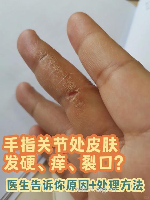 手指开裂湿疹有什么治疗方法？