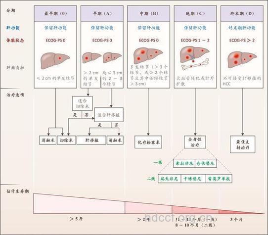 肝癌有哪些分类