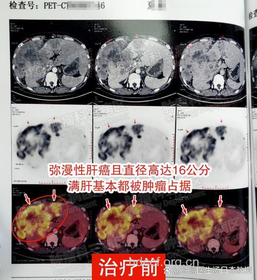 血清肿瘤在肝癌诊断的应用