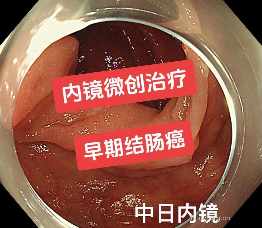 直肠瘤内镜微波疗效果好