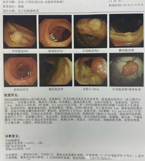 贫血竟然得上结肠癌