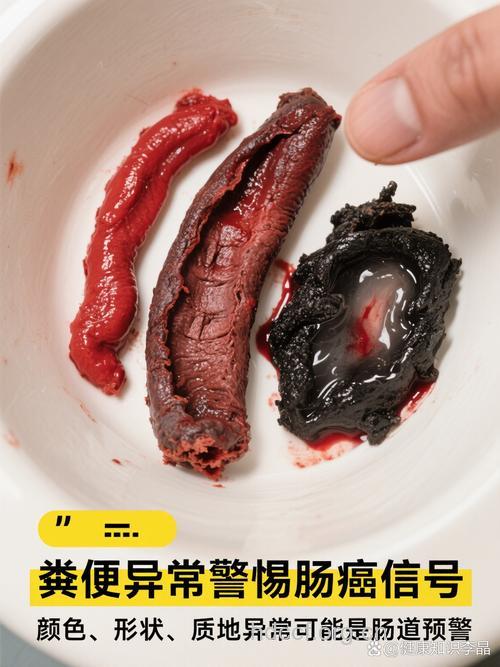 吃出来的大肠癌