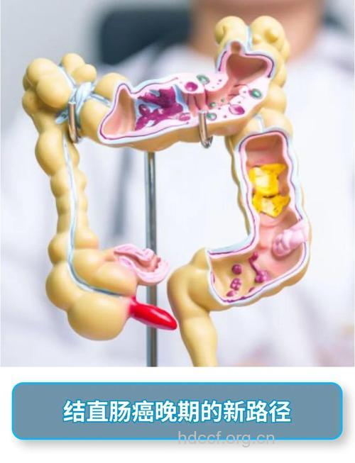 结肠癌的一大新疗法