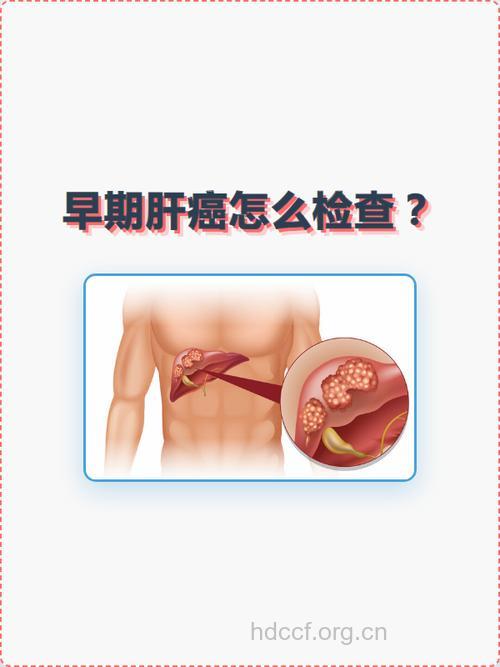 怎么发现早期肝癌?