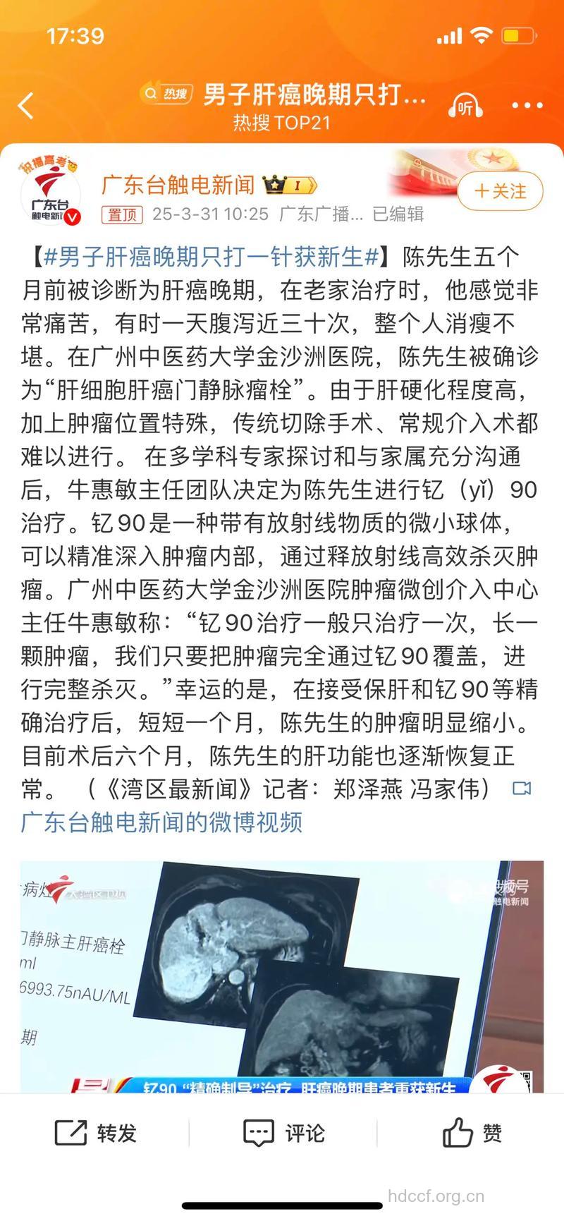 肝癌晚期治疗无可医