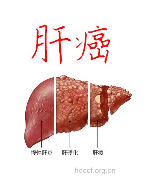 特殊的慢性病——肝癌